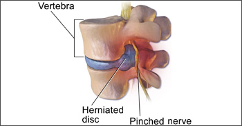 physiotherapie hernie discale 